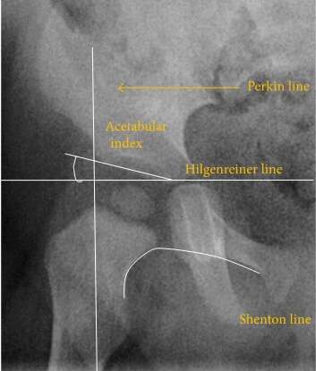 Normal hip.[3]