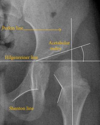 Hip dysplasia.[3]