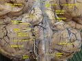 Cerebrum. Inferior view. Deep dissection.