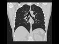 Chest CT (coronal lung window)