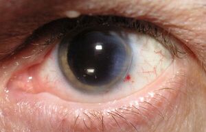 Photo of a left eye with widely dilated pupil. a small red spot on the lower distal side is all that can be seen of the incision.