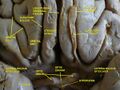 Cerebrum, inferior view, deep dissection.